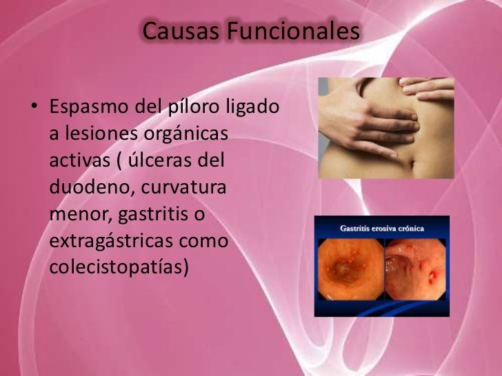 espasmo pilorico